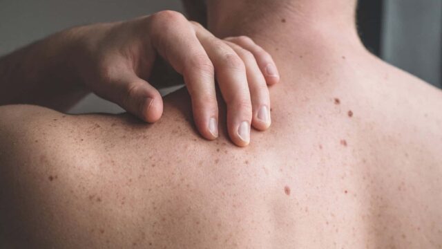A close-up of a hand touching a person's back. There are lots of freckles on their back.