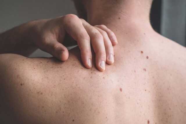 A close-up of a hand touching a person's back. There are lots of freckles on their back.